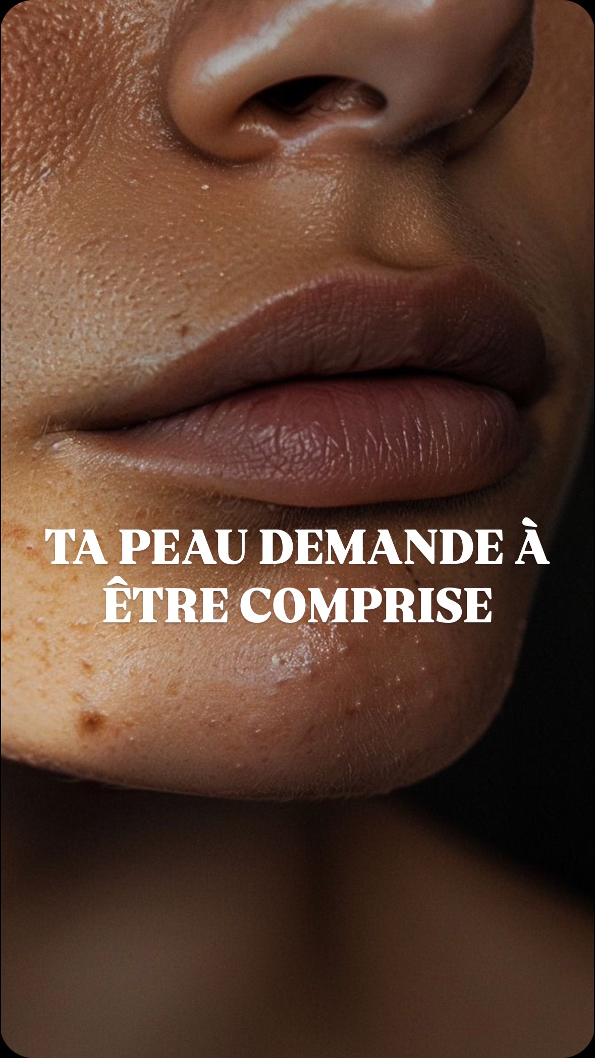 La guérison de sa peau nécessite plus qu’une lotion asséchante et une poudre de super aliment rajoutée à son alimentation.
Il s’agit d’un état de santé chronique et complexe qui nécessite une prise en charge thérapeutique individualisée, interne avant toute chose.
Alors réserve ta consultation avec moi pour voir comment on peut adapter cela à toi, selon tes besoins spécifiques .
Le lien est dans ma bio.
#acné #eczéma #naturopathie #peau #soinnaturel #micronutrition #microbioteintestinal