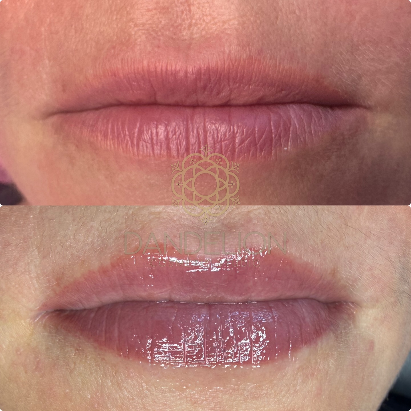Lippenunterspritzung? Nicht immer notwendig ?
Hier sehen wir eine abgeheilte Lippenpigmentierung nach nur 1. Behandlung ????
Eine natürliche Lippenpigmentierung kann wahre Wunder bewirken und sieht dabei noch wunderschön natürlich aus.
Lippenpigmentierung Vorteile ✨
Klare und definierte Konturen ??
Von satten und kräftigen Tönen bis hin zu natürlichen und frischen Farben ❤️??
Optische Vergrößerung durch präzise Pigmentierung ?
Selbstbewussteres Auftreten ??♀️
Und vieles mehr.
Termine online buchen.
#lipblush #lippenpigmentierung #permanentmakeup #potsdam #dandelioncosmetic #pmutraining #liptattoo #pmuworld #permablend