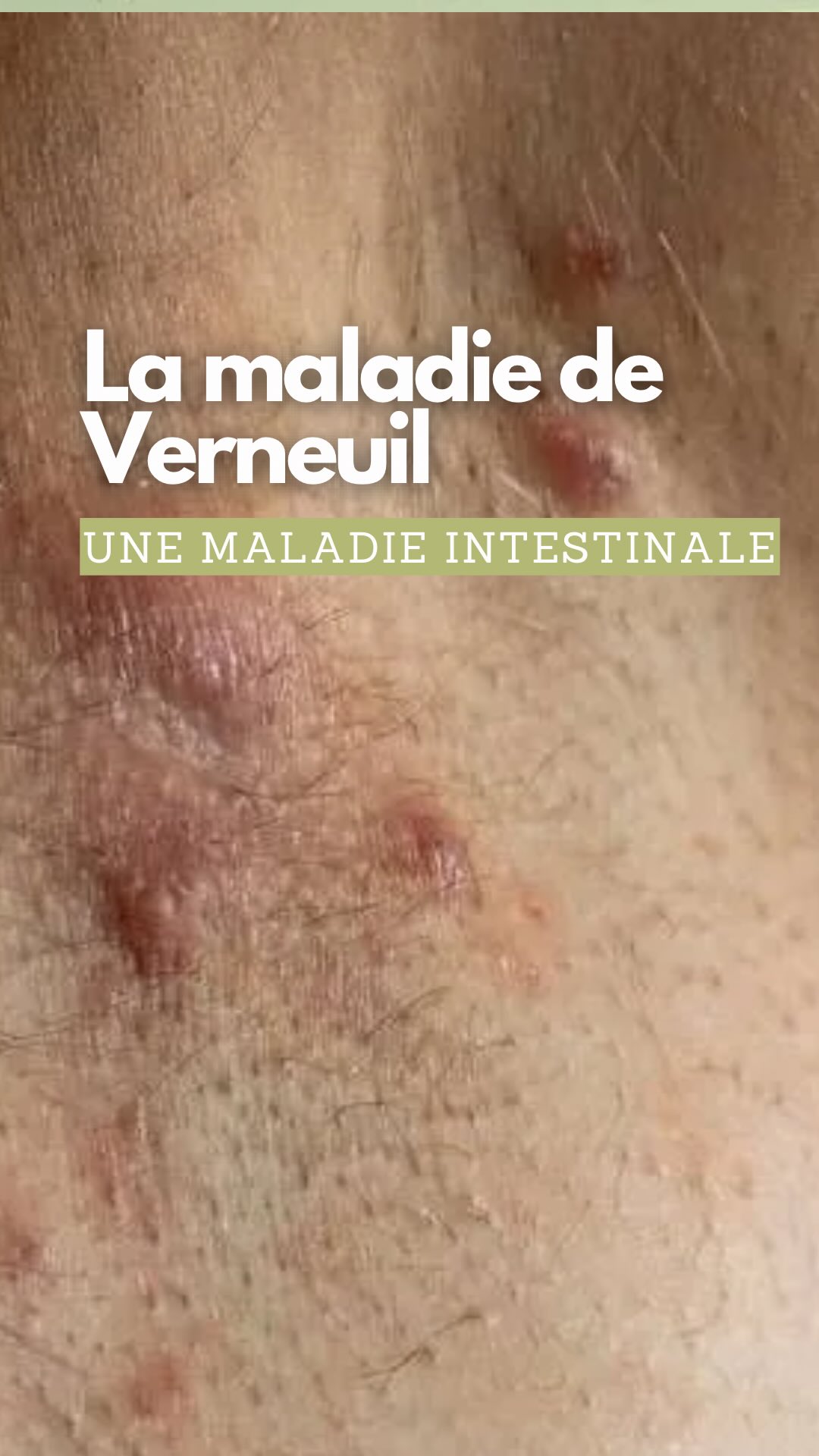 Quel bonheur d’entendre un médecin comme le Professeur Humbert @pr_philippe_humbert parler de la maladie de Verneuil autrement.
Pas juste en surface, mais en allant chercher les causes profondes : digestives et hormonales (notamment liées aux androgènes et à l’insuline).
Les choses avancent !
Et ça fait du bien d’entendre enfin une approche intégrative, qui rejoint ce que la recherche scientifique confirme peu à peu.
Récemment, une étude a montré que la maladie de Verneuil est fortement liée au microbiote intestinal. Réguler ce microbiote, c’est LA clé essentielle si on veut espérer améliorer la maladie.
Pour les curieux·ses qui veulent creuser, voici 2 études passionnantes :
- Insights into Gut Microbiome Composition in Hidradenitis Suppurativa (2024)
https://pmc.ncbi.nlm.nih.gov/articles/PMC11174550/?utm_source=chatgpt.com
- Microbiome in Hidradenitis Suppurativa — What We Know (2022)
https://pmc.ncbi.nlm.nih.gov/articles/PMC9570026/?utm_source=chatgpt.com
Et vous, est-ce que vous êtes convaincus que la MV est lié au ventre et à votre digestion ?
PS : navrée pour la correction automatique du clavier : Professeur Humbert est venerolgoue et non ventriloque.
#maladiedeverneuil #hidrosadenitissuppurativa #hidrosadenitesuppuree #naturopathie #science #microbioteintestinal #micronutrition #parhologiedepeau #maladiedepeau
