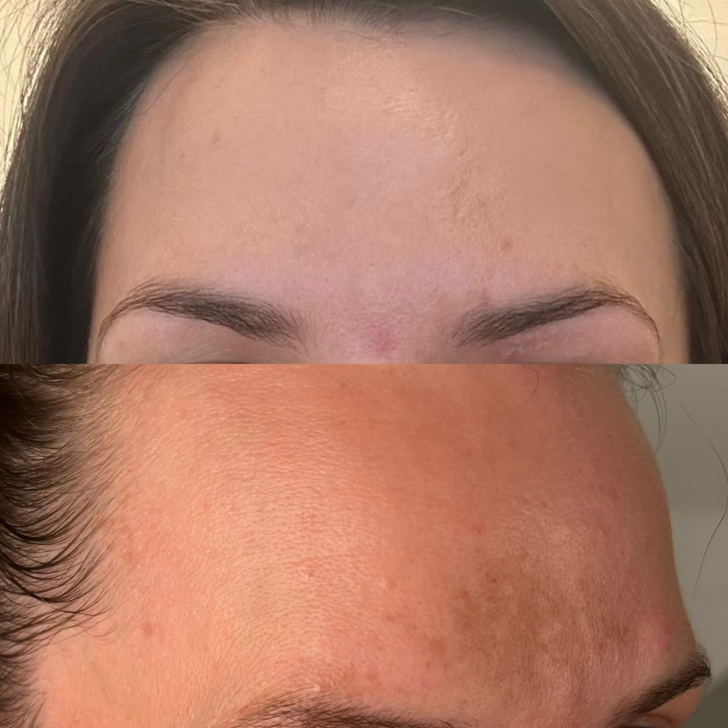 Diese Vorher–Nachher-Aufnahme zeigt, was eine gezielte, indikationsgerechte Hauttherapie bewirken kann.
1 Prodigy Peel Behandlung, 1 Hydrafacial und 2 Produkte von @zoskinhealth für die Heimpflege
Bild 1 vorher / nachher
Bild 2 ist nach intensiver Sonneneinstrahlung
Bild 3 ist nach 1 Hydrafacial + 1 retinolfreies ZO Skin Health Produkt (zur Sommerzeit ist von Retinol und starken Peelings abzusehen. Dennoch sieht man eine Verbesserung)
Bild 4 ist nach 1 Prodigy Peel p2 + 1 retinolhaltigem ZO Skin Health Produkt ( Zum Winter hin starten wir wieder mit intensiven Behandlungen und haben dazu auch Retinol integriert)
? Behandlung & Pflege:
Durch eine individuell abgestimmte Behandlung in Kombination mit den hochwirksamen Produkten von ZO® Skin Health wurde die Haut systematisch regeneriert, ausgeglichen und in ihrer Funktion gestärkt. Der Fokus lag auf Zellerneuerung, Hautbildverfeinerung und Harmonisierung des Hauttons
✨ Ergebnis:
• sichtbar ebenmäßigerer Teint
• verfeinerte Hautstruktur
• reduzierte Pigmentunregelmäßigkeiten
• gesünderes, frisches Hautbild mit mehr Glow
Dieses Ergebnis zeigt, dass Hautgesundheit kein Zufall ist, sondern das Resultat aus fundierter Hautanalyse, medizinischer Wirkstoffkosmetik und konsequenter Anwendung.
? Jede Haut ist individuell – deshalb ist eine professionelle Beratung der Schlüssel zu nachhaltigen Ergebnissen.
Informationen | Terminvereinbarung
? 0162/ 1723052 - WhatsApp
? info@skinconcept-Hannover.de
? www.skinconcept-Hannover.de
Kosmetik Hannover | hydrafacial Hannover | Hautanalyse Hannover | Microneedling Hannover | dauerhafte Haarentfernung Hannover