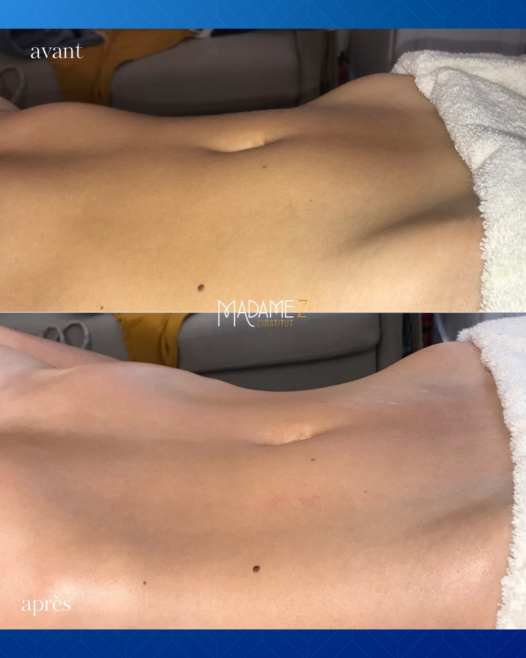 ✨ LA MÉTHODE RENATA FRANÇA ✨
Vous en avez assez des méthodes de drainage classiques qui donnent des résultats limités et éphémères ?
Oubliez les manœuvres lentes et les pompages doux, cette technique est tout autre : c'est un massage tonique, dynamique et précis. Un protocole réglé comme une horloge pour des résultats qui vous éblouiront !
Le drainage Renata França tient ses promesses. Vous vous sentirez libérée d'un poids, avec un ventre plus plat et des jambes légères. Les résultats sont souvent immédiats, voire visibles dès la première séance, mais en général, ils s'observent entre 1 et 3 séances.
Cependant, gardez à l'esprit que ces effets bluffants à court terme ne doivent pas faire oublier l'importance d'une bonne hygiène de vie et d'une activité sportive régulière. Le drainage brésilien Renata França est d'autant plus efficace lorsqu'il est associé à une prise en charge personnelle adaptée.
Prenez rendez-vous dès aujourd’hui et profitez d’un bilan corps offert ! ?
…………………………………………….
? Virginie facialiste & kératothérapeute dédiée à sublimer votre peau
? Faisons rayonner votre confiance & révélons votre beauté naturelle
? Institut spécialisé en soins pour le corps et le visage - 10 Passage du Grand Cerf, 75002 Paris
.
.
.
#soindelapeau #micneur #pertepoids #institutdebeauté #skincare #soincorps #esthétique #drainagelymphatique