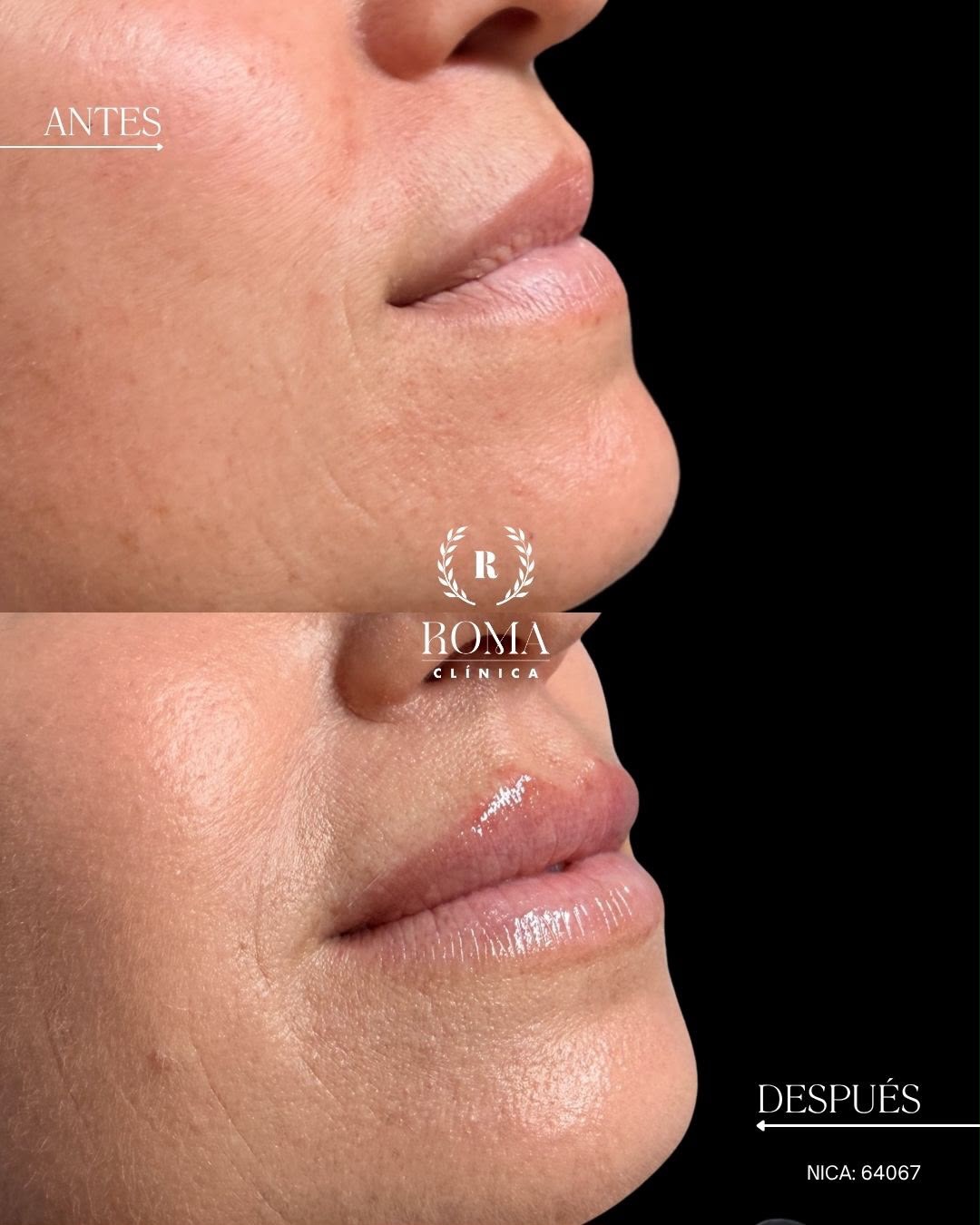 ¿Aumento de labios o hidratación?
No siempre buscamos más volumen. En este caso, después del verano, sus labios necesitaban hidratación, jugosidad y un aspecto más fresco.
El objetivo: respetar su forma natural y conseguir unos labios visiblemente más hidratados y cuidados.
Porque cada labio necesita un tratamiento diferente. ¿Tú qué buscas: volumen o hidratación?
“Resultados individuales. Cada paciente puede obtener resultados diferentes. Valoración médica previa necesaria.”
📲 951 536 845 / 655 538 090
📍 Dirección: Trinidad Grund 7, 1D, Málaga Centro
🌐 Página web: www.clinicasroma.com
#AumentoDeLabios #malaga #hidratacion #labios #clinicaroma