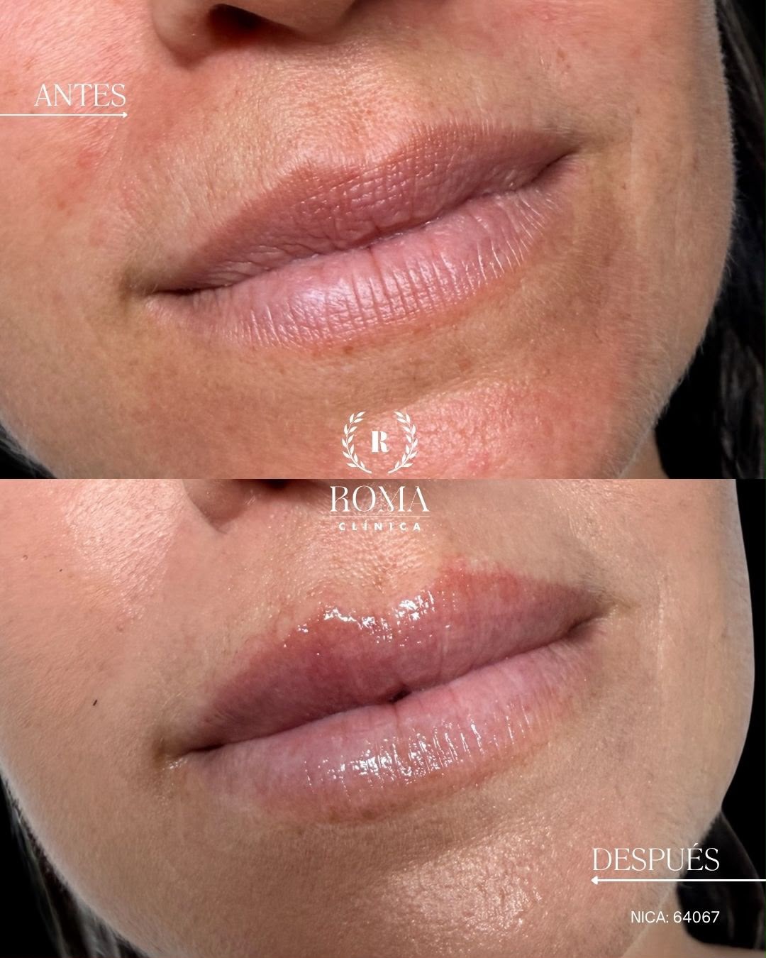 ¿Aumento de labios o hidratación?
No siempre buscamos más volumen. En este caso, después del verano, sus labios necesitaban hidratación, jugosidad y un aspecto más fresco.
El objetivo: respetar su forma natural y conseguir unos labios visiblemente más hidratados y cuidados.
Porque cada labio necesita un tratamiento diferente. ¿Tú qué buscas: volumen o hidratación?
“Resultados individuales. Cada paciente puede obtener resultados diferentes. Valoración médica previa necesaria.”
📲 951 536 845 / 655 538 090
📍 Dirección: Trinidad Grund 7, 1D, Málaga Centro
🌐 Página web: www.clinicasroma.com
#AumentoDeLabios #malaga #hidratacion #labios #clinicaroma